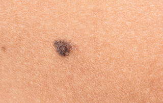 Window Film Can Reduce Skin-Cancer Risk