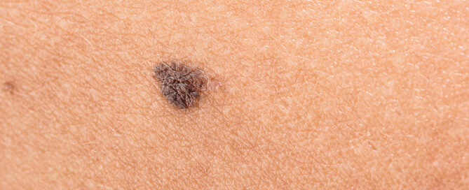 Window Film Can Reduce Skin-Cancer Risk